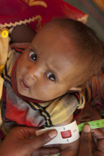 Ein Kind in Äthiopien wird auf Mangelernährung untersucht (Foto: UNICEF Ethiopia) Mangelernährung